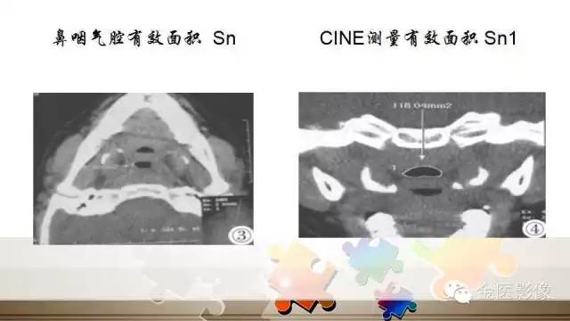 腺样体肥大的影像诊断