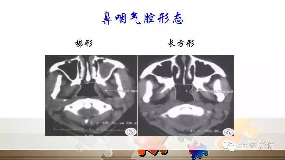 腺样体肥大的影像诊断