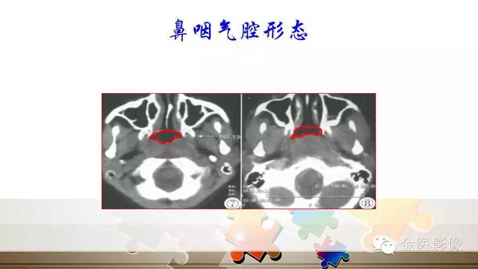 腺样体肥大的影像诊断