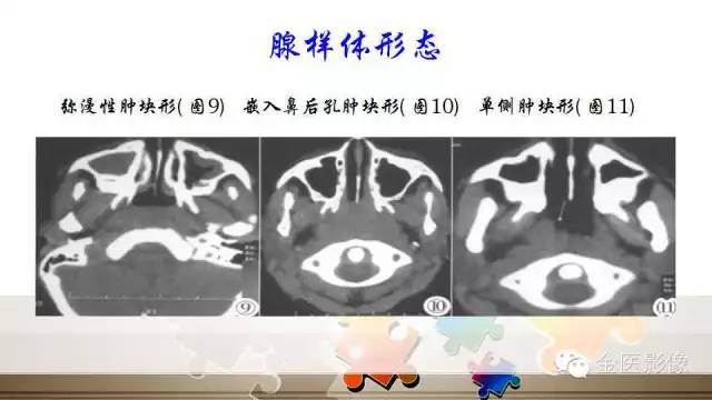 腺样体肥大的影像诊断