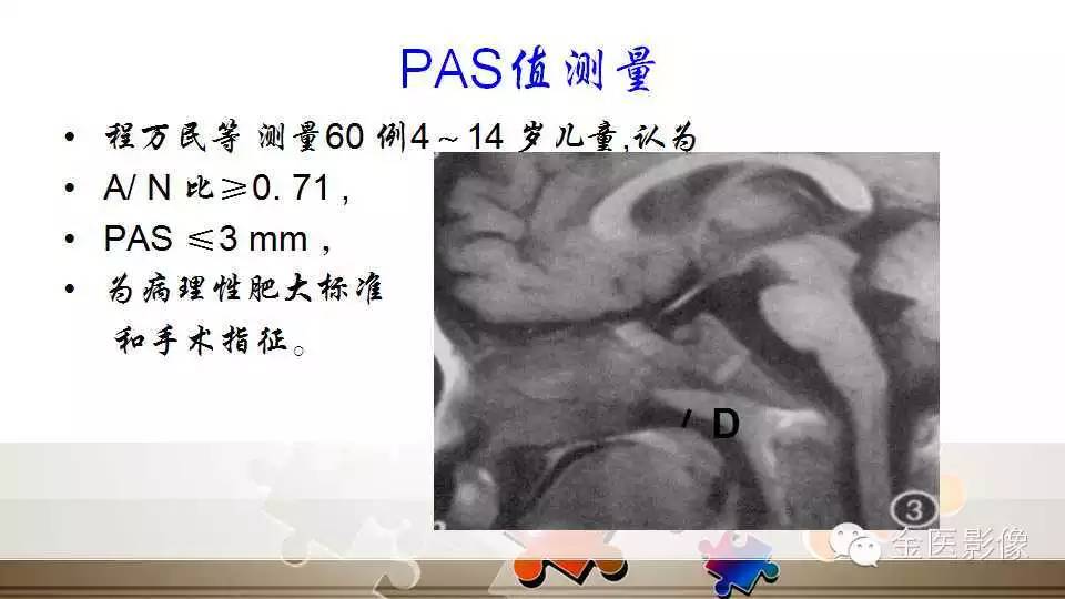 腺样体肥大的影像诊断