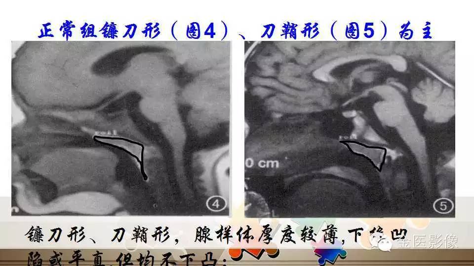腺样体肥大的影像诊断
