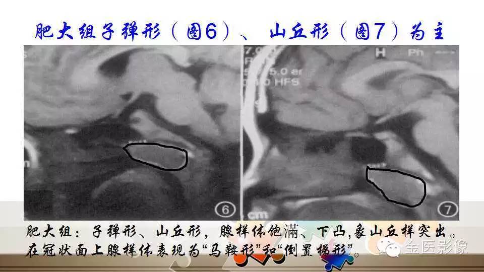 腺样体肥大的影像诊断
