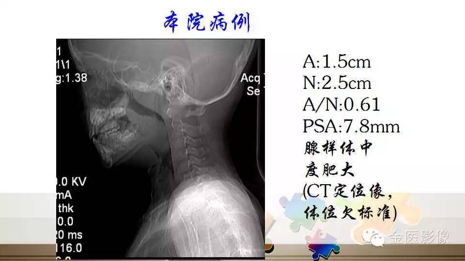 腺样体肥大的影像诊断