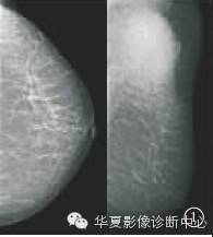 【病例学习】乳腺炎性肌纤维母细胞瘤1例