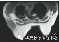 【病例学习】乳腺炎性肌纤维母细胞瘤1例 【病例学习】乳腺炎性肌纤维母细胞瘤1例