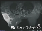 【病例学习】乳腺炎性肌纤维母细胞瘤1例 【病例学习】乳腺炎性肌纤维母细胞瘤1例