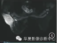 【病例学习】乳腺炎性肌纤维母细胞瘤1例 【病例学习】乳腺炎性肌纤维母细胞瘤1例