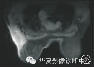 【病例学习】乳腺炎性肌纤维母细胞瘤1例 【病例学习】乳腺炎性肌纤维母细胞瘤1例