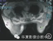 【病例学习】乳腺炎性肌纤维母细胞瘤1例 【病例学习】乳腺炎性肌纤维母细胞瘤1例