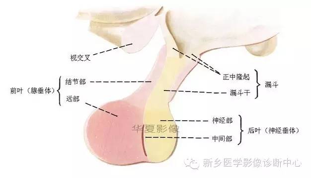 垂体柄阻断综合征的MR影像表现 垂体柄阻断综合征的MR影像表现