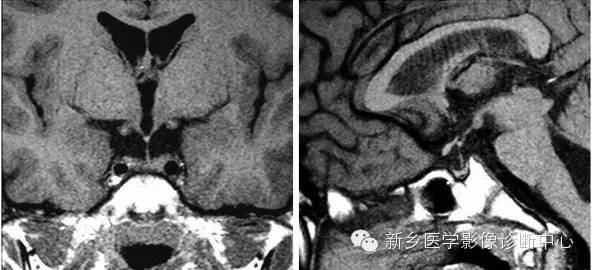 垂体柄阻断综合征的MR影像表现