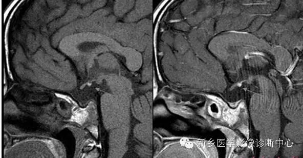 垂体柄阻断综合征的MR影像表现 垂体柄阻断综合征的MR影像表现
