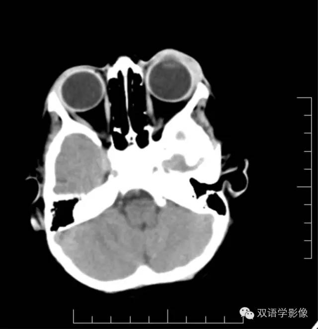 【双语病例】角膜葡萄肿一例CT影像表现 【双语病例】角膜葡萄肿一例CT影像表现