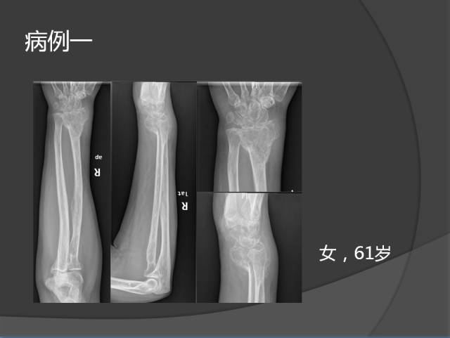 骨转移瘤的临床及影像表现