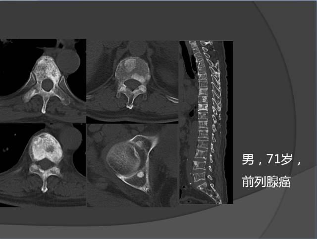 骨转移瘤的临床及影像表现