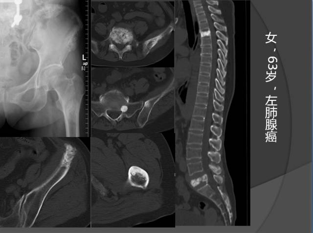 骨转移瘤的临床及影像表现