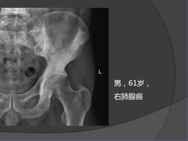 骨转移瘤的临床及影像表现