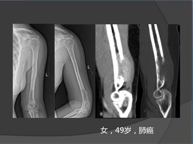 骨转移瘤的临床及影像表现