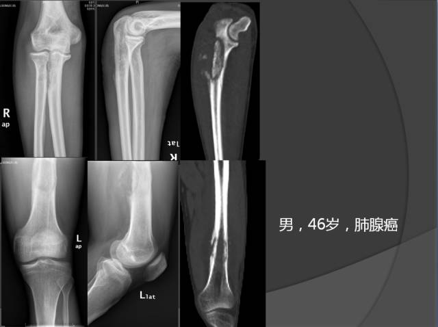 骨转移瘤的临床及影像表现