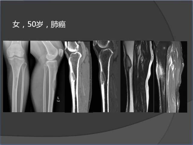 骨转移瘤的临床及影像表现