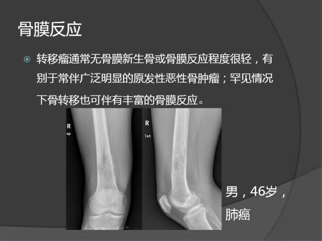 骨转移瘤的临床及影像表现
