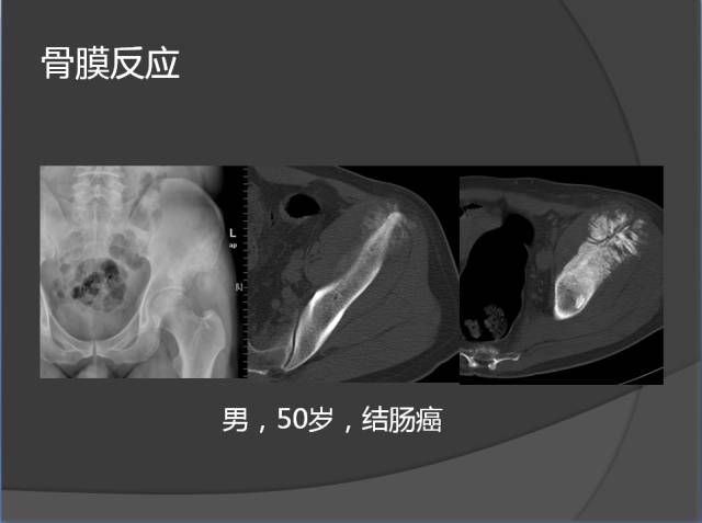 骨转移瘤的临床及影像表现