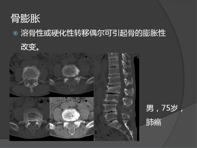骨转移瘤的临床及影像表现