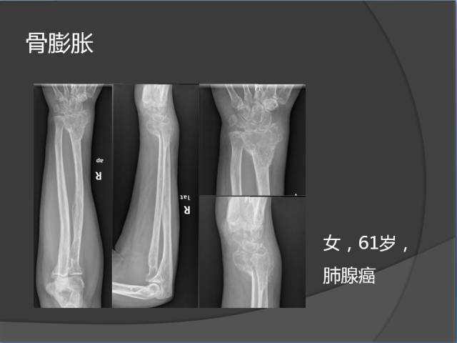 骨转移瘤的临床及影像表现