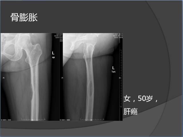 骨转移瘤的临床及影像表现