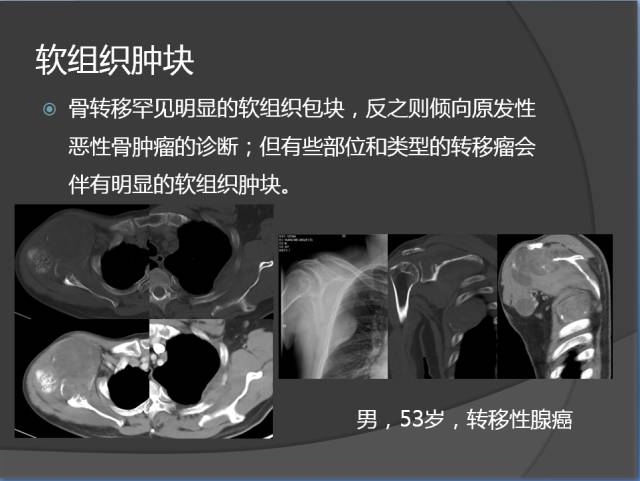 骨转移瘤的临床及影像表现