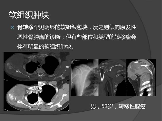 骨转移瘤的临床及影像表现