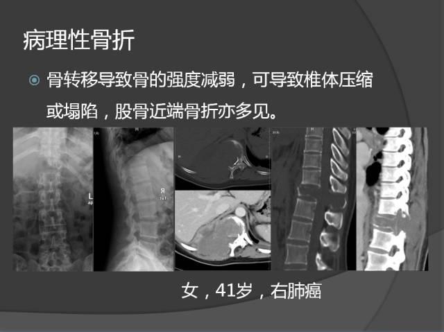 骨转移瘤的临床及影像表现