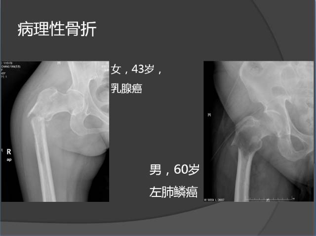 骨转移瘤的临床及影像表现