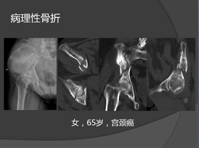 骨转移瘤的临床及影像表现