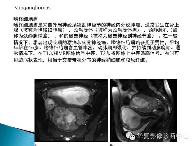骶前肿物的影像分析