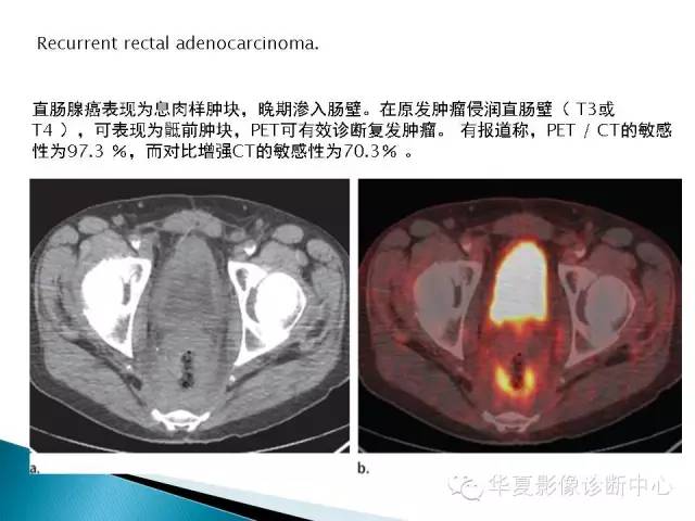 骶前肿物的影像分析