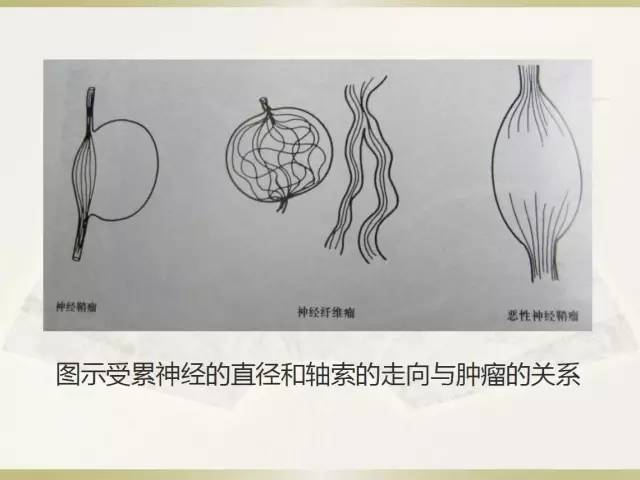 关于部分外周神经源性肿瘤的关系的初探