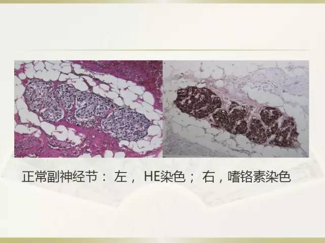 关于部分外周神经源性肿瘤的关系的初探