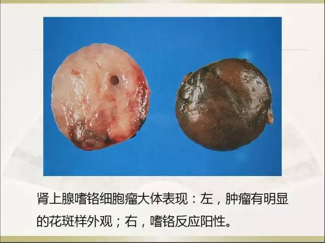 关于部分外周神经源性肿瘤的关系的初探