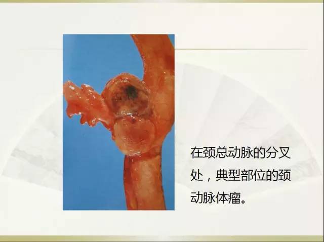 关于部分外周神经源性肿瘤的关系的初探