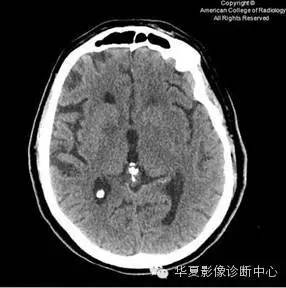 【双语病例】血管周围间隙扩大