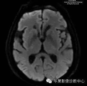 【双语病例】血管周围间隙扩大 【双语病例】血管周围间隙扩大
