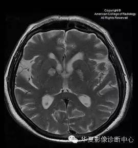 【双语病例】血管周围间隙扩大 【双语病例】血管周围间隙扩大