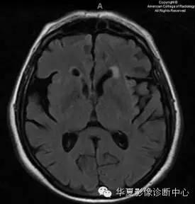 【双语病例】血管周围间隙扩大 【双语病例】血管周围间隙扩大