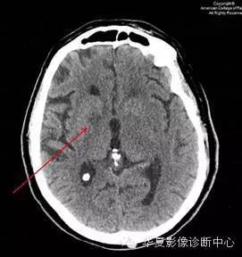 【双语病例】血管周围间隙扩大 【双语病例】血管周围间隙扩大