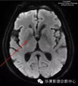 【双语病例】血管周围间隙扩大 【双语病例】血管周围间隙扩大