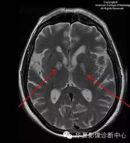 【双语病例】血管周围间隙扩大 【双语病例】血管周围间隙扩大