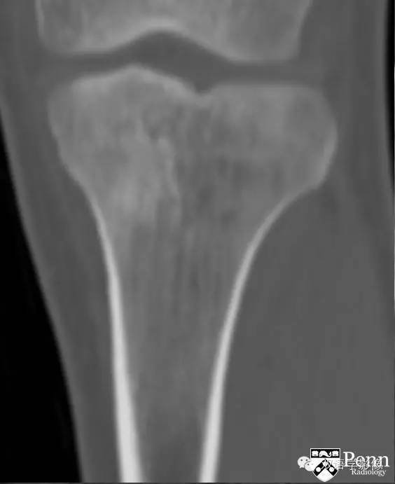 【双语病例】骨原发性淋巴瘤一例影像表现