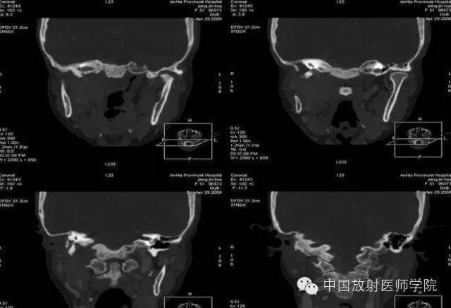 【病例学习】异位脑膜瘤一例CT影像表现 【病例学习】异位脑膜瘤一例CT影像表现